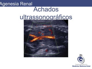 Achados
ultrassonográficos
Agenesia Renal
 