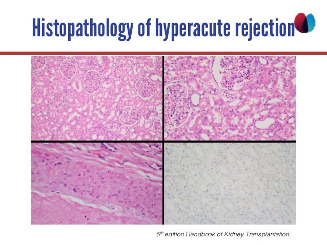 Acute Allograft Rejection In Kidney Transplantation 2017 Chaken
