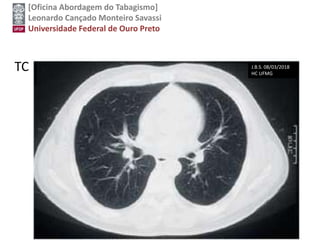 [Oficina Abordagem do Tabagismo]
Leonardo Cançado Monteiro Savassi
Universidade Federal de Ouro Preto
TC J.B.S. 08/03/2018
HC UFMG
 