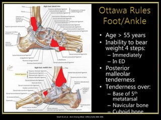 • Age > 55 years
• Inability to bear
weight 4 steps:
– Immediately
– In ED
• Posterior
malleolar
tenderness
• Tenderness over:
– Base of 5th
metatarsal
– Navicular bone
– Cuboid bone
Stiell IG et al. Ann Emerg Med. 1992;21(4):384-390.
 
