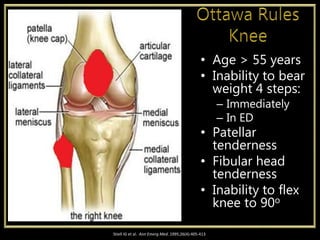 • Age > 55 years
• Inability to bear
weight 4 steps:
– Immediately
– In ED
• Patellar
tenderness
• Fibular head
tenderness
• Inability to flex
knee to 90o
Stiell IG et al. Ann Emerg Med. 1995;26(4):405-413
 