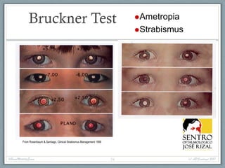 Bruckner Test ®Ametropia
®Strabismus
From Rosenbaum & Santiago, Clinical Strabismus Management 1999
#BasicMotilityExam (c) APSantiago 201724
 