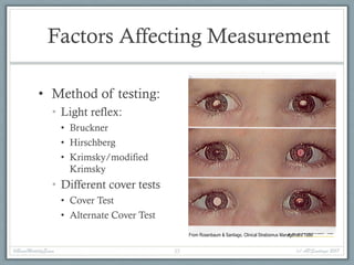 Factors Affecting Measurement
• Method of testing:
• Light reflex:
• Bruckner
• Hirschberg
• Krimsky/modified
Krimsky
• Different cover tests
• Cover Test
• Alternate Cover Test
From Rosenbaum & Santiago, Clinical Strabismus Management 1999
#BasicMotilityExam (c) APSantiago 201735
 