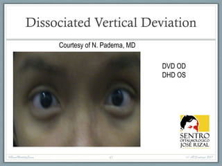 Dissociated Vertical Deviation
Courtesy of N. Paderna, MD
#BasicMotilityExam (c) APSantiago 201745
DVD OD
DHD OS
 