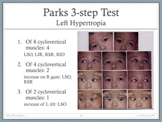 Parks 3-step Test
Left Hypertropia
1. Of 8 cyclovertical
muscles: 4
LSO, LIR, RSR, RIO
2. Of 4 cyclovertical
muscles: 2
increase on R gaze: LSO,
RSR
3. Of 2 cyclovertical
muscles: 1
increase of L tilt: LSO
#BasicMotilityExam (c) APSantiago 201749
 