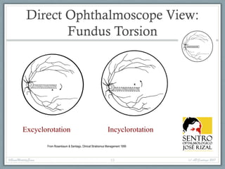 Direct Ophthalmoscope View:
Fundus Torsion
Excyclorotation Incyclorotation
From Rosenbaum & Santiago, Clinical Strabismus Management 1999
#BasicMotilityExam (c) APSantiago 201753
 