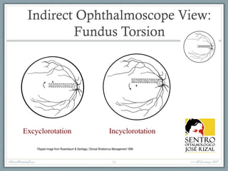Indirect Ophthalmoscope View:
Fundus Torsion
Excyclorotation Incyclorotation
#BasicMotilityExam (c) APSantiago 201754
Flipped image from Rosenbaum & Santiago, Clinical Strabismus Management 1999
 