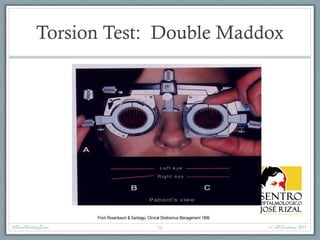 Torsion Test: Double Maddox
From Rosenbaum & Santiago, Clinical Strabismus Management 1999
#BasicMotilityExam (c) APSantiago 201756
 