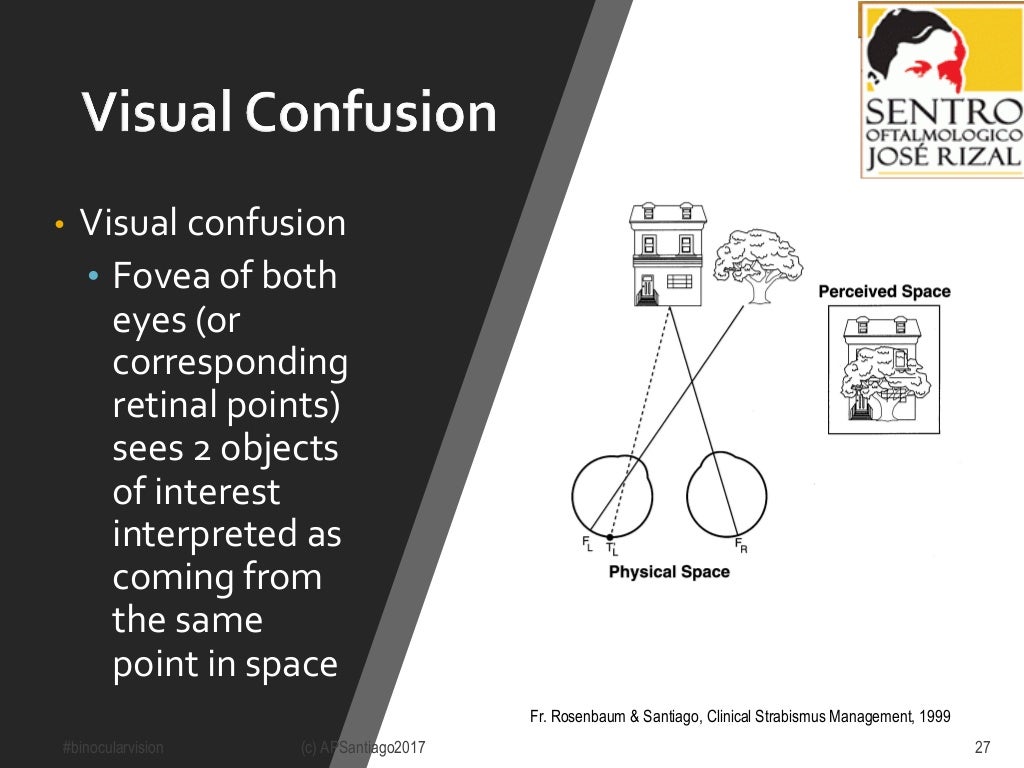 2017 Binocular Vision & Amblyopia