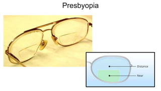 Presbyopia
 
