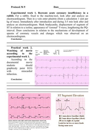 Protocol № 9 Date_____________________
Experimental work 1. Recreate acute coronary insufficiency in a
rabbit. For a rabbit, fixed to the machine-tool, look after and analyze an
electrocardiogram. Then in a vein enter pituitrin (from a calculation 1 unit per
kg of mass). Immediately after introduction and during 3-5 min look after and
analyze an electrocardiogram. Mark bradycardia, displacement of segment of
ST in relation to a isoline, appearance of “coronal” T-wave, lengthening the PQ-
interval. Draw conclusions in relation to the mechanisms of development of
spasms of coronary vessels and changes which was observed on an
electrocardiogram.
Conclusion: ___________________________________________________________
Practical work 2.
Watching of movie
according to the
experimental work 1.
According to the
documental movie
students should
graphicaly paint ECG
with miocardial
infarction.
Conclusion:
_____________________
45
 