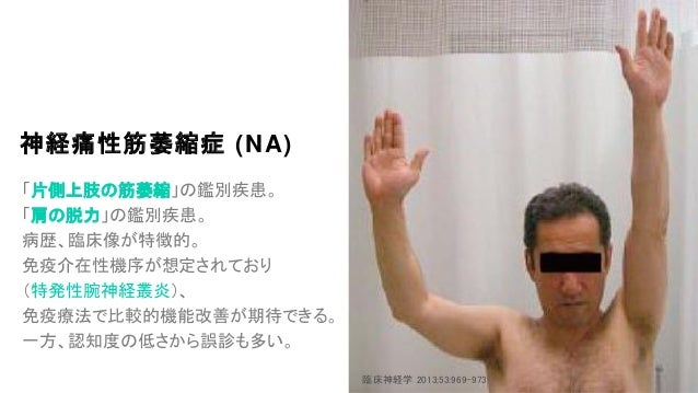 「神経痛性筋萎縮症」の画像検索結果