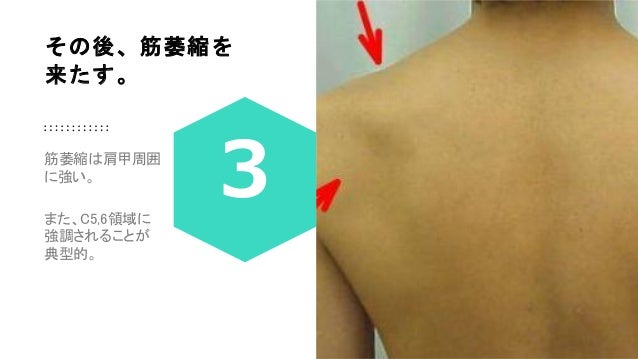 筋萎縮は肩甲周囲
に強い。
また、C5,6領域に
強調されることが
典型的。
その後、筋萎縮を
来たす。
 