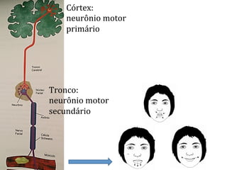 Córtex:	
  
neurônio	
  motor	
  
primário	
  
Tronco:	
  
neurônio	
  motor	
  
secundário	
  
 