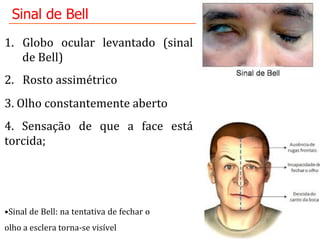 Sinal de Bell
• Sinal	
  de	
  Bell:	
  na	
  tentativa	
  de	
  fechar	
  o	
  
olho	
  a	
  esclera	
  torna-­‐se	
  visível	
  	
  	
  
1.  Globo	
   ocular	
   levantado	
   (sinal	
  
de	
  Bell)	
  	
  
2.  Rosto	
  assimétrico	
  
3.	
  Olho	
  constantemente	
  aberto	
  
4.	
   Sensação	
   de	
   que	
   a	
   face	
   está	
  
torcida;	
  	
  
	
  	
  
 