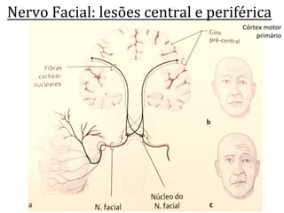 Nervo	
  Facial:	
  lesões	
  central	
  e	
  periférica	
  
Córtex	
  motor	
  
primário	
  
 