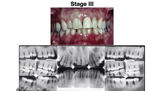 Bsp Classification 2017 NEW PERIODONTAL CLASSIFICATION.pptx