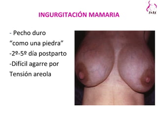 INGURGITACIÓN MAMARIA
- Pecho duro
“como una piedra”
-2º-5º día postparto
-Difícil agarre por
Tensión areola
 