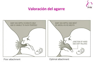 Valoración del agarre
 
