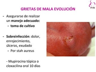 GRIETAS DE MALA EVOLUCIÓN
- Asegurarse de realizar
un manejo adecuado:
- toma de cultivo
- Sobreinfección: dolor,
enrojecimiento,
úlceras, exudado
- Por stah aureus
- Mupirocina tópica o
cloxacilina oral 10 días
 