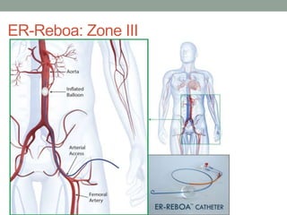 ER-Reboa: Zone III
 