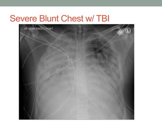 Severe Blunt Chest w/ TBI
 