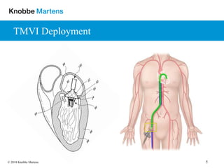 5© 2018 Knobbe Martens
TMVI Deployment
 