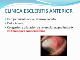 CLINICA ESCLERITIS ANTERIOR
 Enrojecimiento ocular, difuso o nodular
 Dolor intenso
 Congestión y dilatación de la vasc...