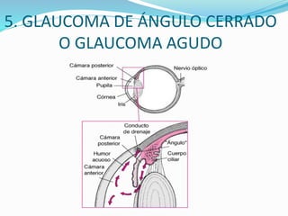 5. GLAUCOMA DE ÁNGULO CERRADO
O GLAUCOMA AGUDO
 