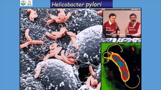Helicobacter pylori
 