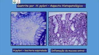 Gastrite por H. pylori – Aspecto Histopatológico
H.pylori – bacteria espiralada Inflamação da mucosa antral
 
