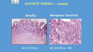 GASTRITE CRÔNICA - evolução
Metaplasia IntestinalAtrofia
GC Atrófica GC Atrófica + MI
 