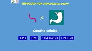 INFECÇÃO POR Helicobacter pylori
X
Gastrite crônica
UPD CARCINOMA LINFOMAUPG
 