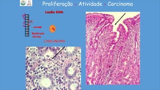 Proliferação - Atividade - Carcinoma
Radicais
livres
Lesão DNA
CARCINOMA
 