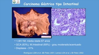 • 1,9H:1M; média idade 67 anos
• GCA (83%), M.Intestinal (69%) - grau moderado/acentuado
• Displasia - 31%
Carcinoma Gástrico tipo Intestinal
Rodrigues LGM et al JBr Patol, 2001; Lemes LOA et al, J Br Patol, 2002
 