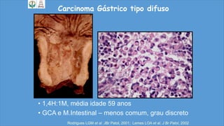Carcinoma Gástrico tipo difuso
• 1,4H:1M, média idade 59 anos
• GCA e M.Intestinal – menos comum, grau discreto
Rodrigues LGM et al JBr Patol, 2001; Lemes LOA et al, J Br Patol, 2002
 