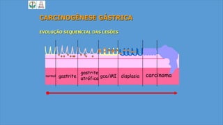 CARCINOGÊNESE GÁSTRICA
EVOLUÇÃO SEQUENCIAL DAS LESÕES
gastrite
gastrite
atrófica gca/MI displasianormal carcinoma
 