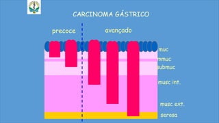 CARCINOMA GÁSTRICO
precoce avançado
muc
mmuc
submuc
musc int.
musc ext.
serosa
 