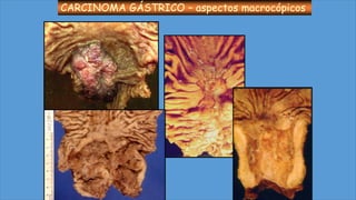 CARCINOMA GÁSTRICO – aspectos macrocópicos
 