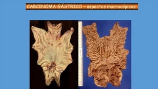 CARCINOMA GÁSTRICO – aspectos macrocópicos
 