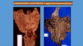 CARCINOMA GÁSTRICO – aspectos macrocópicos
 