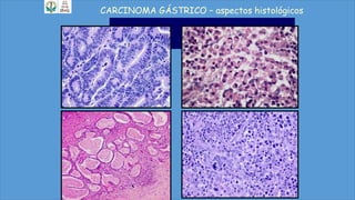 CARCINOMA GÁSTRICO – aspectos histológicos
 