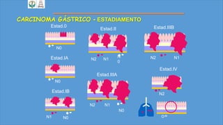 CARCINOMA GÁSTRICO - ESTADIAMENTO
Estad.IB
N1 N0
Estad.0
N0
Estad.IA
N0
Estad.II
N
0
N1N2
Estad.IIIA
N0
N1N2
Estad.IIIB
N1N2
Estad.IV
N2
 