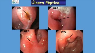 Úlcera Péptica
UPD
UPD
UPG
UPG
 