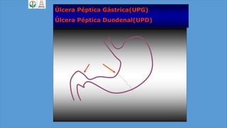 Úlcera Péptica Gástrica(UPG)
Úlcera Péptica Duodenal(UPD)
 