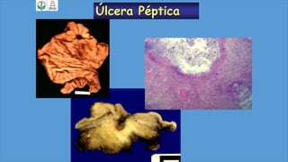 Úlcera Péptica
 