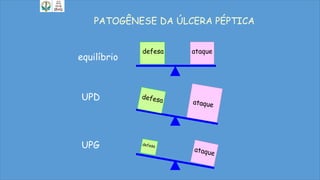 PATOGÊNESE DA ÚLCERA PÉPTICA
equilíbrio
ataque
UPD
UPG
defesa
 
