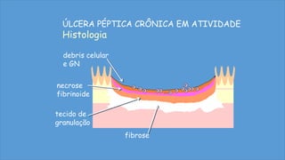 debris celular
e GN
necrose
fibrinoide
tecido de
granulação
fibrose
ÚLCERA PÉPTICA CRÔNICA EM ATIVIDADE
Histologia
 