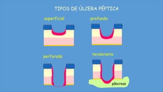 TIPOS DE ÚLCERA PÉPTICA
superficial profunda
perfurada
terebrante
pâncreas
 