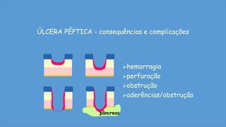 ÚLCERA PÉPTICA - consequências e complicações
pâncreas
hemorragia
perfuração
obstrução
aderências/obstrução
 